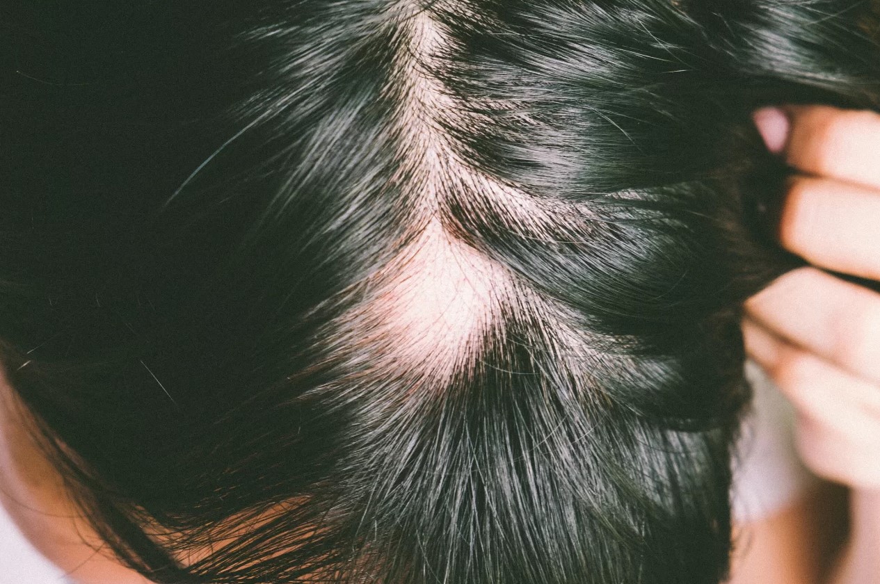 Alopecia areata: Características - Fuemedicalcenter.com