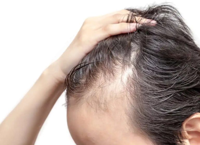 error gris Componer Pérdida de pelo y sus principales causas
